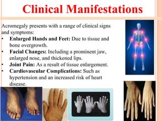 Clinical Manifestations
Acromegaly presents with a range of clinical signs
and symptoms:
• Enlarged Hands and Feet: Due to tissue and
bone overgrowth.
• Facial Changes: Including a prominent jaw,
enlarged nose, and thickened lips.
• Joint Pain: As a result of tissue enlargement.
• Cardiovascular Complications: Such as
hypertension and an increased risk of heart
disease.
 